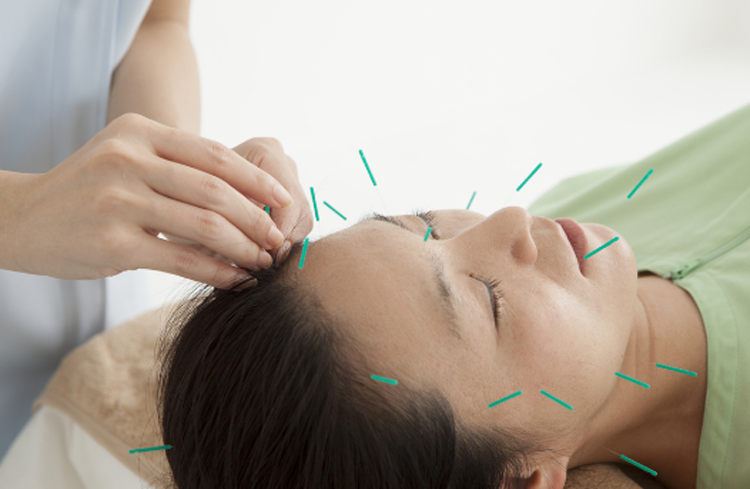 Điện mãng châm điều trị viêm mũi xoang (Viêm xoang cấp; Viêm xoang mạn) (Tụy uyên)